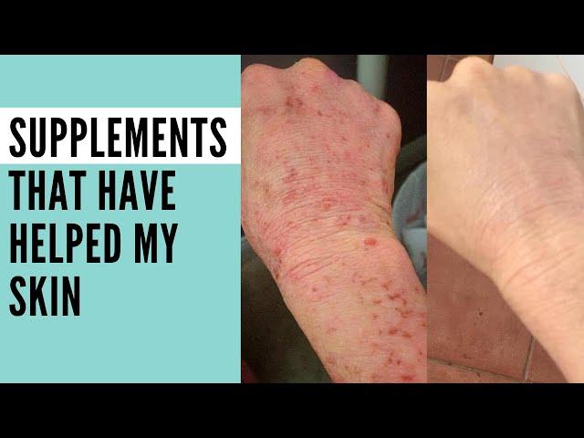 What supplements did I use to heal my eczema?