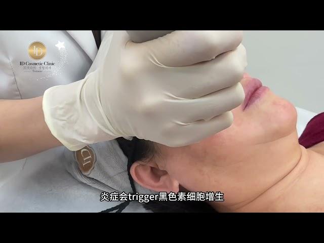 Toronto ID Cosmetic Clinic ｜多伦多ID医美诊所 徐医生神奇的红血丝消失术