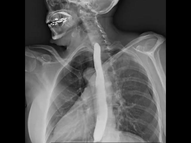 Dynamic X-Ray Retrospective View of the Esophagus in Motion | Konica Minolta Healthcare