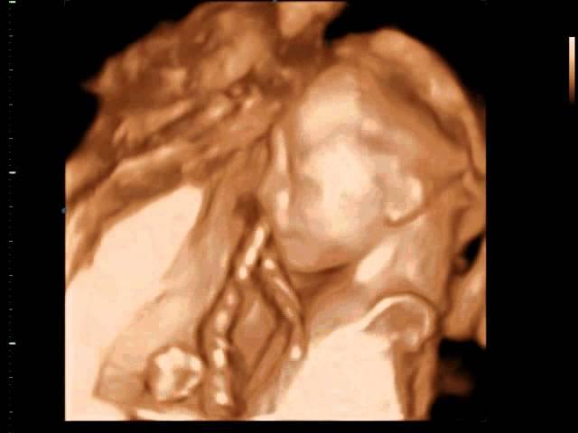 3D Ultrasound  - baby 20 weeks -3D Sono Image