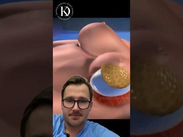 Демонстрация увеличения груди #пластическийхирург