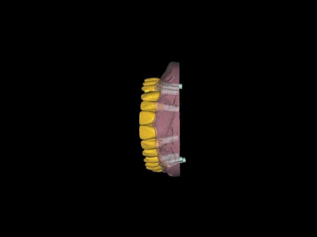 FP1 temporary 3D printed bridge#dental #dentalcadcam #digitaldentistry #dentaltechnology