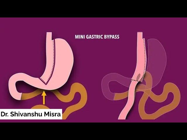 MINI GASTRIC BYPASS SURGERY FOR MORBID OBESITY - A STEP BY STEP NARRATIVE  | DR SHIVANSHU MISRA