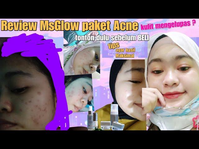 Review 3 bulanan pakai Ms Glow paket acne #msglow