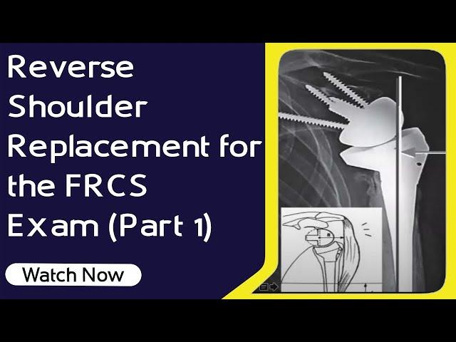 Reverse Shoulder Arthroplasty for FRCS Ortho Exam | Biomechanics