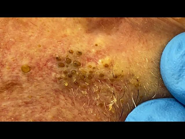 Extremely Clogged Pores Extracted | Contour Dermatology