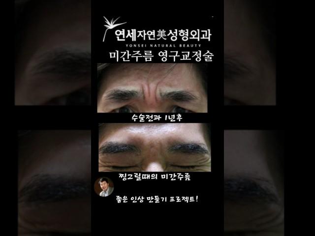 미간주름  영구교정술 사례분석3 #연세자연미성형외과 #필러NO #보톡스N0   #미간필러 #미간보톡스 #신촌성형외과 #홍대성형외과 #은평성형외과 #마포성형외과 #미간주름잘하는곳