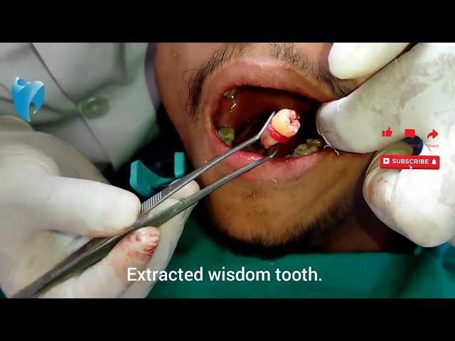 Surgical Extraction of Wisdom Tooth! Bright Line Dental Care Dr. Swostik Devkota Nepali Dentist