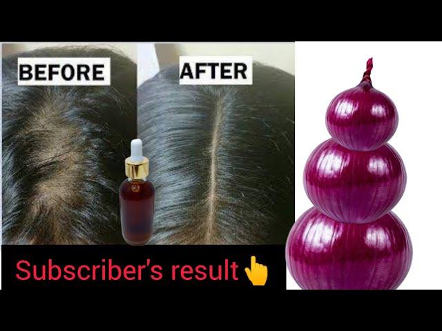 Stop  Hair Fall 100% Faster Growth Magical Onion Juice at Home|take the challenge 