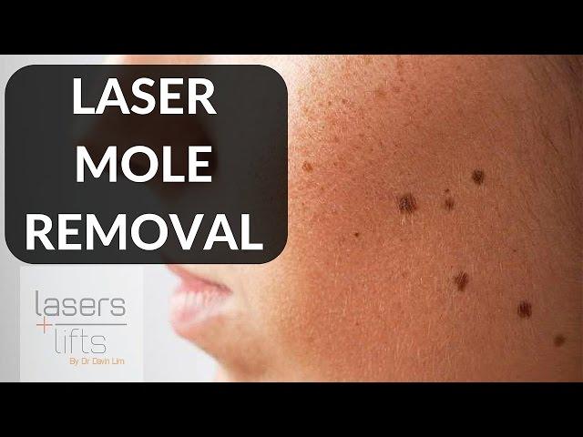 LASER MOLE REMOVAL