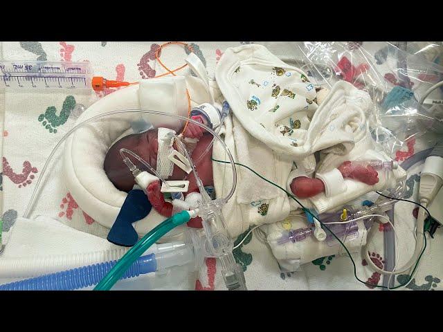 Baby Born at 22 Weeks Saved by Sacramento Firefighters and UC Davis