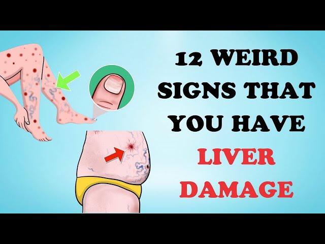 Warning: 12 Weird Signs That Show You're Having Liver Damage