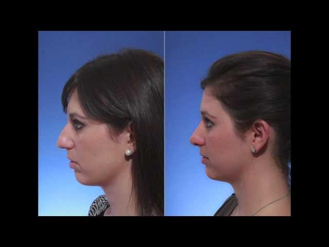 Dr Jacob Steiger Review After Rhinoplasty in Boca Raton