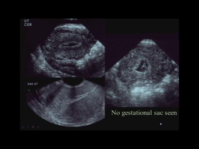 sonography of Ectopic Pregnancy