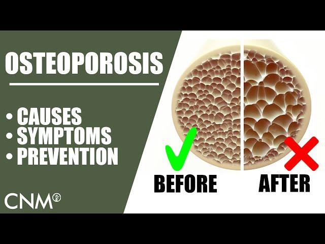 OSTEOPOROSIS: The Natural Way To Prevent It