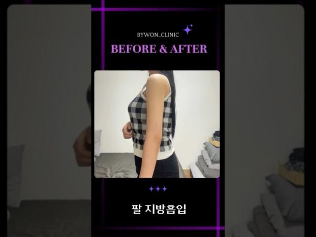 팔 지방흡입 후기 #지방흡입후기