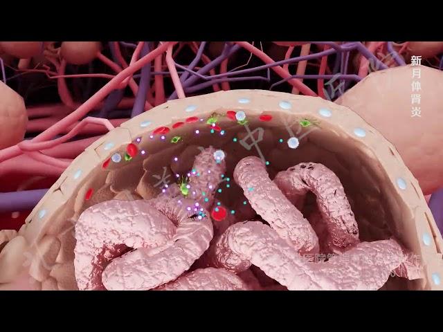 glomerulonephritis