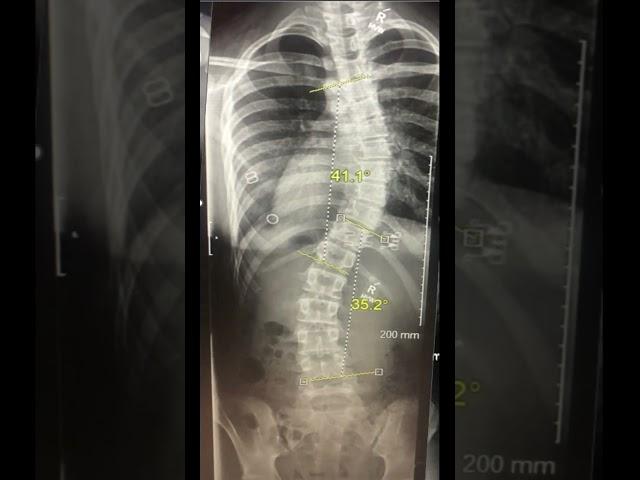 6 months of the non-surgical ASMI treatment for Scoliosis