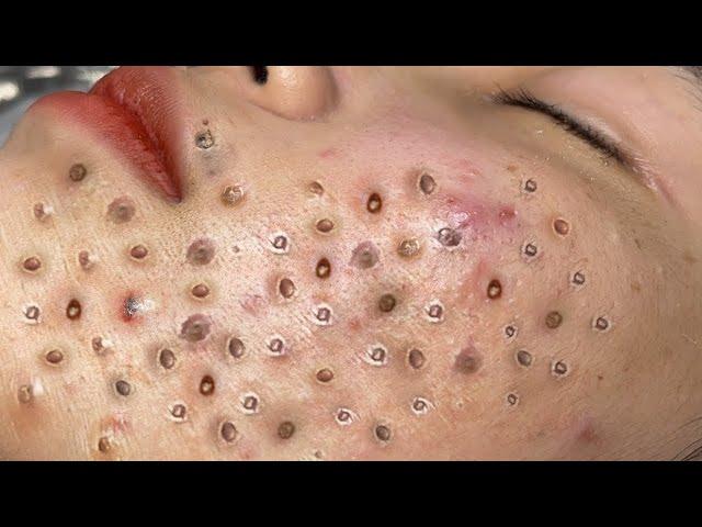 Blackhead Removal With Sac Dep Spa @10007285