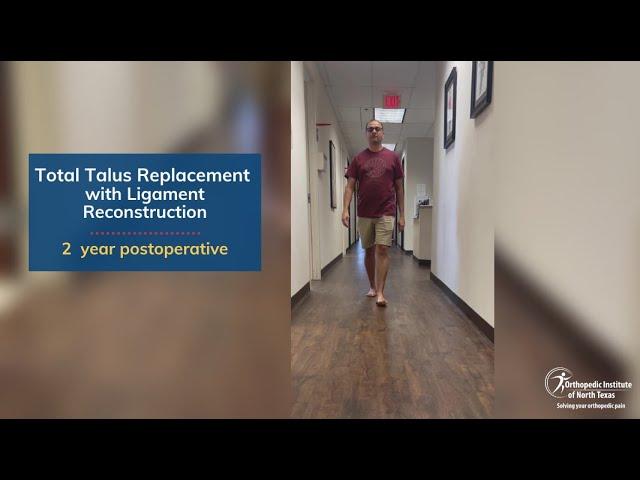 Patient 2 years after 3D total talus replacement for avascular necrosis surgery with Dr. Justin Kane