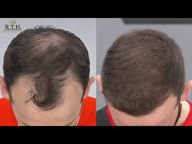 FUE метод пересадки волос  Real Trans Hair. Доктор Игорь Цхай