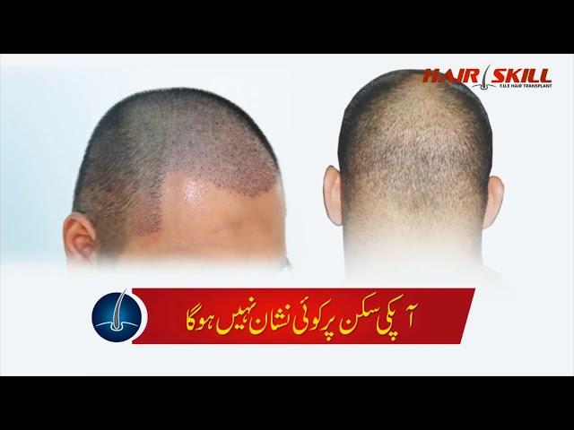 Hair Skill - Hair Transplant in Karachi - Surgical and Non Surgical
