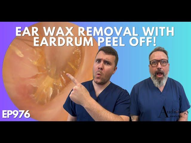 EAR WAX REMOVAL WITH EARDRUM PEEL OFF - EP976