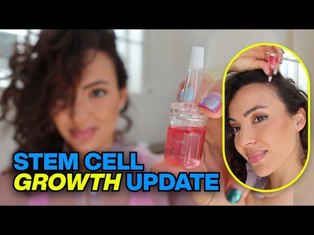 Stem Cell Hair Growth Update (Calecim UPDATE on My Hair Loss)