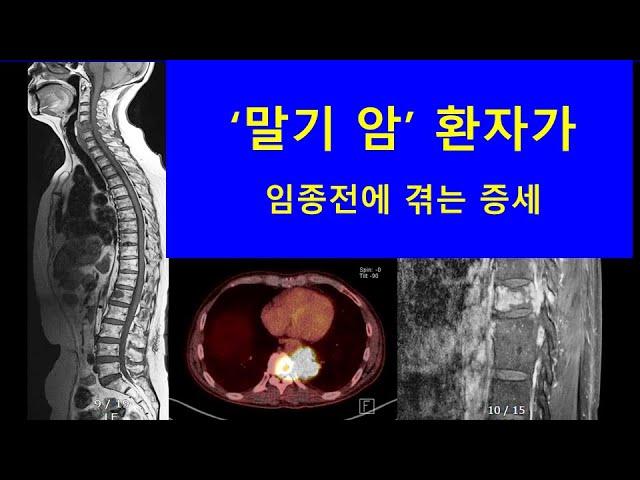 ‘말기 암’ 환자가 임종전에 겪는 증상