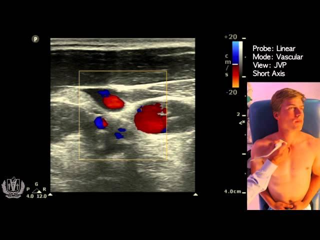JVP (Jugular Venous Pulsation) Evaluation using Ultrasound