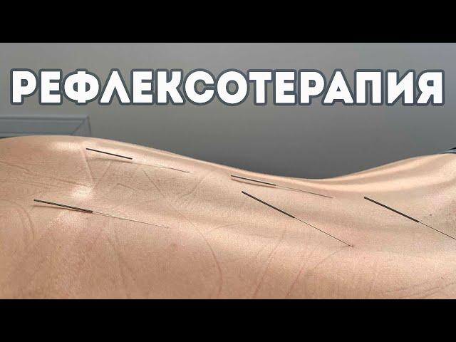 Рефлексотерапия (иглорефлексотерапия, акупунктура)