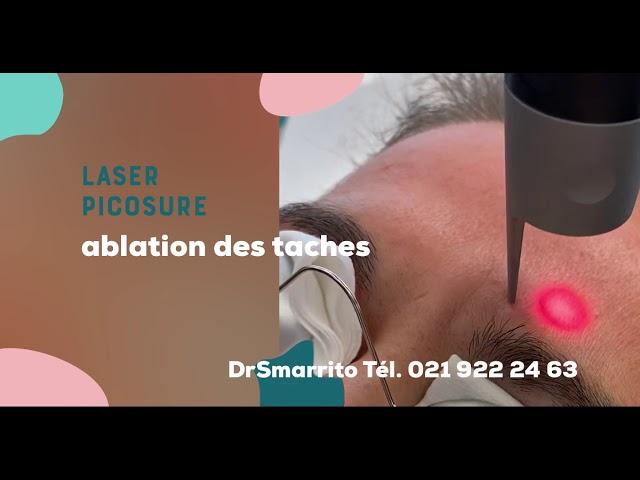 laser picosure : une méthode révolutionnaire pour éclaircir le tient