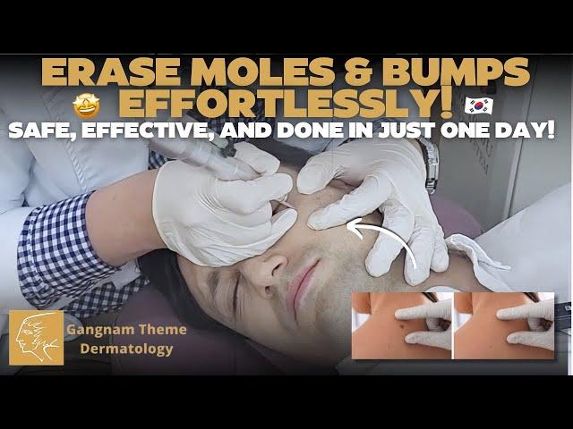  Bump-Free Skin in a Day: CO2 Laser Mole Removal! 