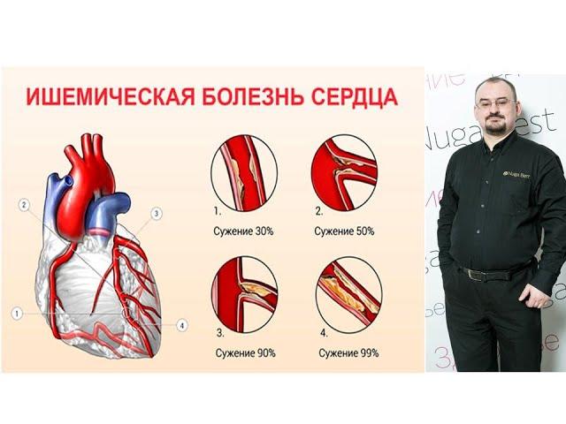 Ишемическая болезнь сердца – проявления