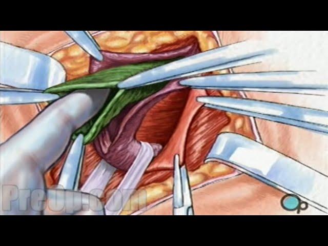 Hernia Repair Inguinal (Open) Surgery Patient Education