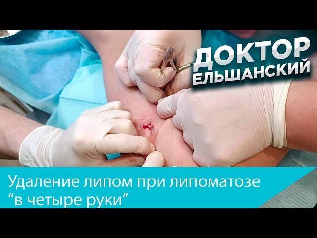 Удаление липом при липоматозе "в четыре руки"