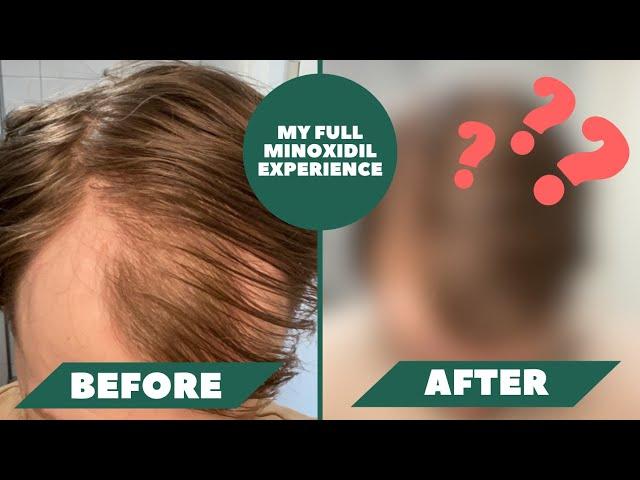 I Have Been Using Minoxidil For 1 Year And Here Are The Results - My Full Minoxidil Experience