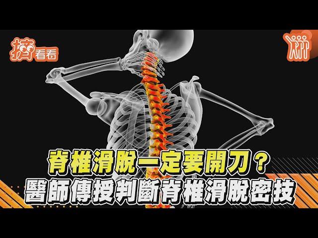 脊椎滑脫一定要開刀? 醫師傳授判斷脊椎滑脫密技｜TVBS新聞｜擠看看