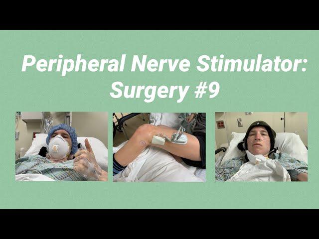 Peripheral Nerve Stimulator: Surgery Day