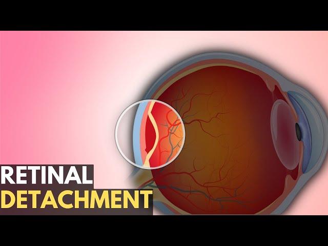 Retinal Detachment: Everything You Need To Know