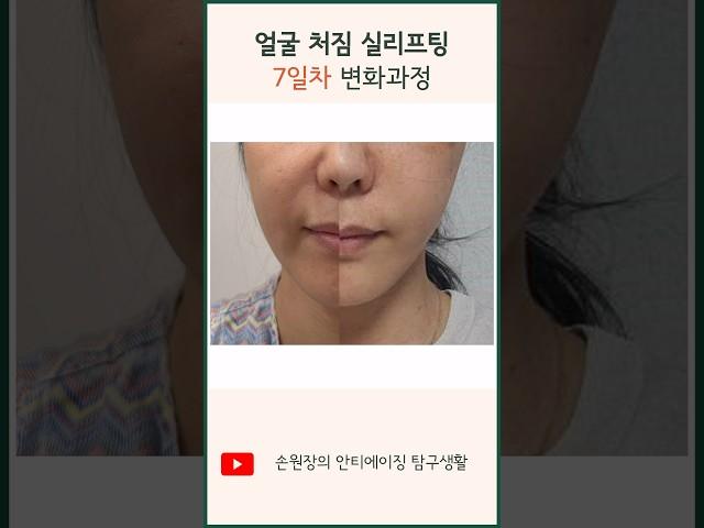 얼굴 처짐 실리프팅 7일 변화 과정 | 전후 브이라인 팔자주름 #실리프팅 #리프팅 #lifting #모즈클리닉 #modsclinic
