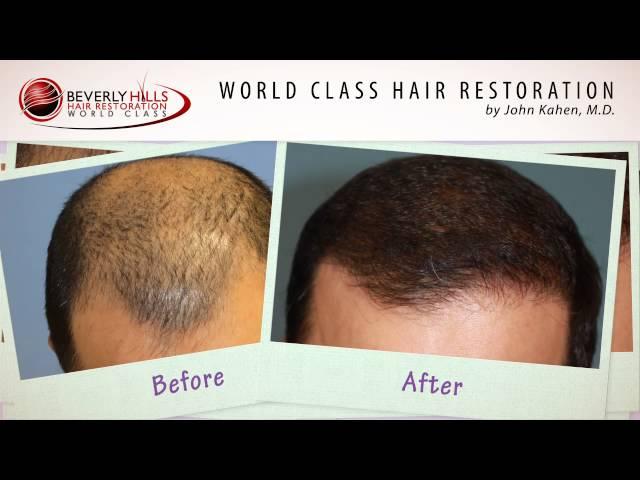 Cirugia de transplante de cabello FUT- video de resultados naturales- antes y despues