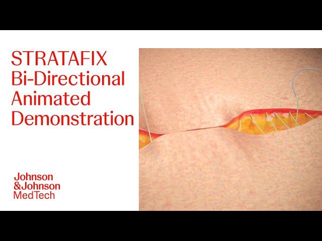 Animation of STRATAFIX Bi-directional Closure | J&J MedTech