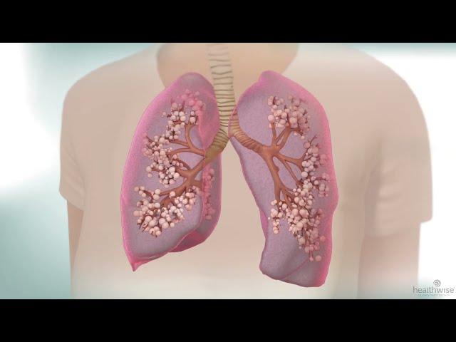 Healthwise 3D Digital Animations