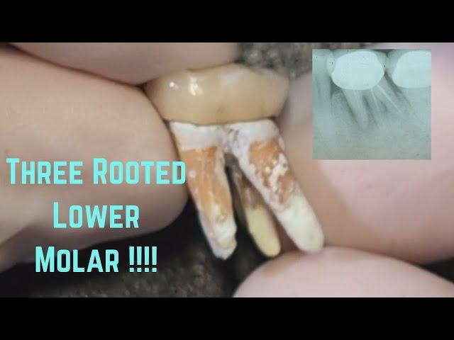 3 rooted lower molar