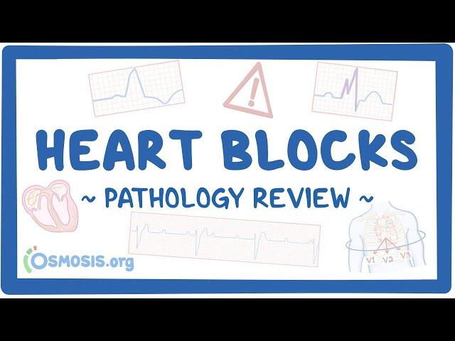 Heart blocks: Pathology Review