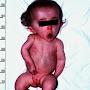 @osteogenesiscongenita7600