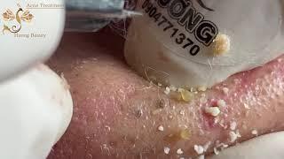 Make your Acne Treatment Huong Da Nang | 419