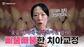 "웃을 때마다 앞니가 신경쓰여요" 삐뚤빼뚤한 치아교정 결과는?