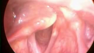 Vocal Cord Paralysis